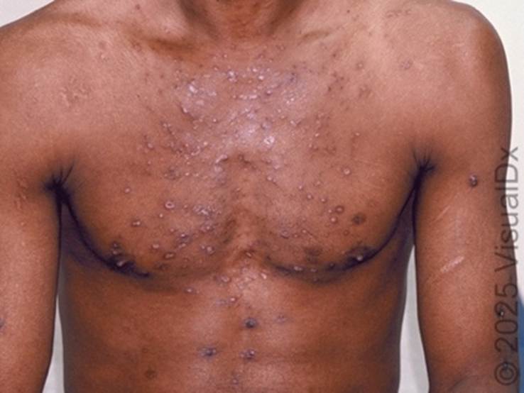 Eosinophilic folliculitis