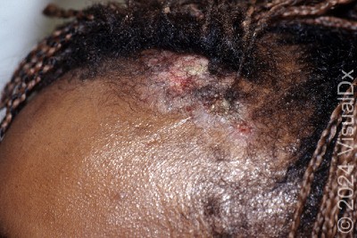 63-Year-Old Female With Growth on Scalp 63-Year-Old Female With Growth on Scalp