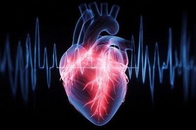 Gout Linked to Tachyarrhythmia