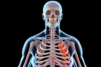 Demographic and Clinical Predictors of Rib Fracture
