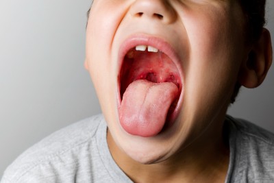 Image Identification of Streptococcus in Children