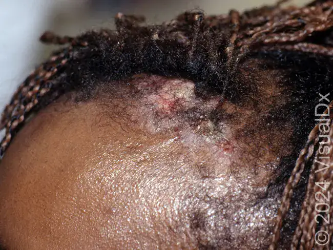 female with discoloration on forehead, cancer, Bowen disease