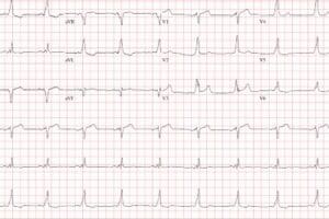 ECG of Palpitations From Ventricular Pre-excitation in Urgent Care