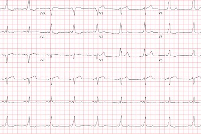 86-Year-Old With Palpitations