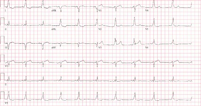 EGC OF An 86-year-old male presents to urgent care with intermittent palpitations indicating ventricular pre-excitation