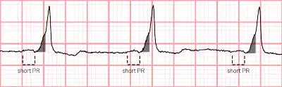 Wave pattern for Ventricular pre-excitation on an ECG in urgent care