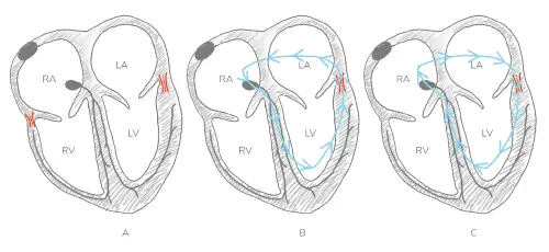 Diagram explaining Wolf-Parkinson-White (WPW) syndrome