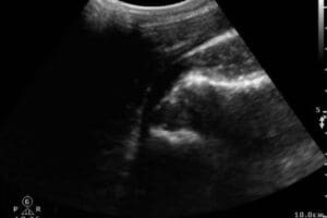 POCUS of an Anterior Shoulder Dislocation in Urgent Care