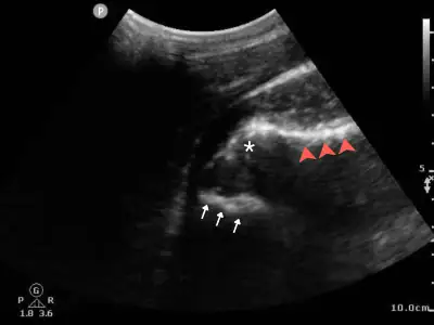 POCUS of an Anterior Shoulder Dislocation in Urgent Care