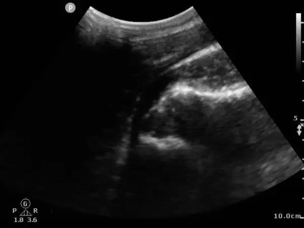 Initial POCUS Image of an Anterior Shoulder Dislocation in Urgent Care