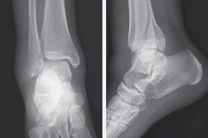 X-ray of unstable ankle injury, Weber B/C type injury