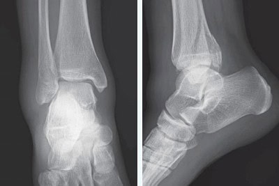 28-Year-Old Female With Rolled Right Ankle