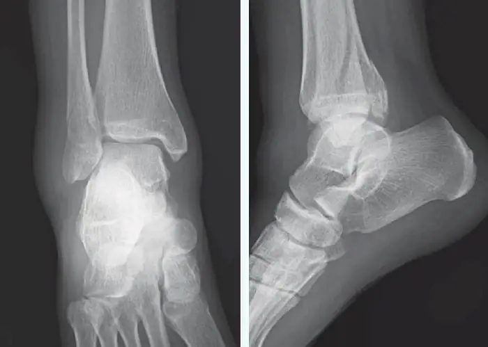 X-ray Image of a Female Who Rolled Her Ankle
