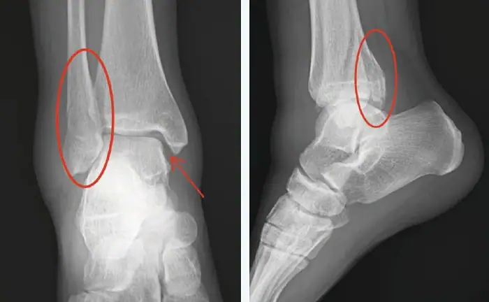 X-ray of rolled ankle resolved, unstable ankle fracture