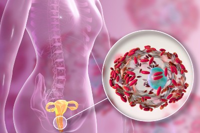 Bacterial Vaginosis vs STI Coinfection