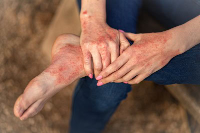 Oral Antihistamines Don’t Help Atopic Dermatitis