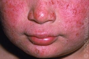 Actinic Prurigo Rash in Urgent Care