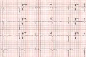 Limb Lead Reversal ECG