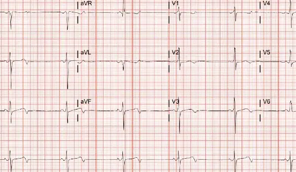 83-Year-Old Female With Palpitations 83-Year-Old Female With Palpitations