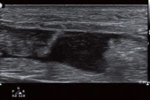 POCUS Achilles Rupture in Urgent Care