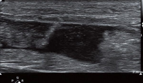 64-Year-Old With Acute Posterior Ankle Pain 64-Year-Old With Acute Posterior Ankle Pain