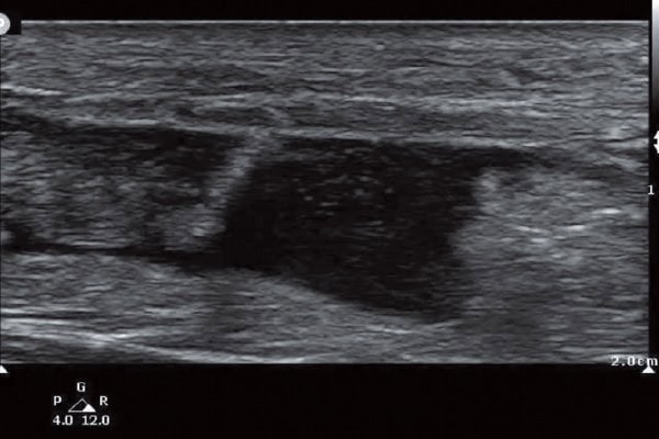 64-Year-Old With Acute Posterior Ankle Pain