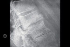 Vertebral Compression Fractures in Urgent Care