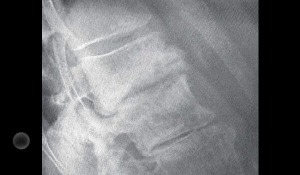 79-Year-Old Female With Acute Back Pain 79-Year-Old Female With Acute Back Pain