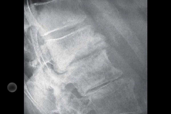 79-Year-Old Female With Acute Back Pain
