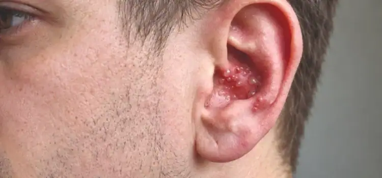 Ramsay Hunt Syndrome—Early Recognition of Herpes Zoster Oticus in Urgent Care: A Case Report Ramsay Hunt Syndrome—Early Recognition of Herpes Zoster Oticus in Urgent Care: A Case Report