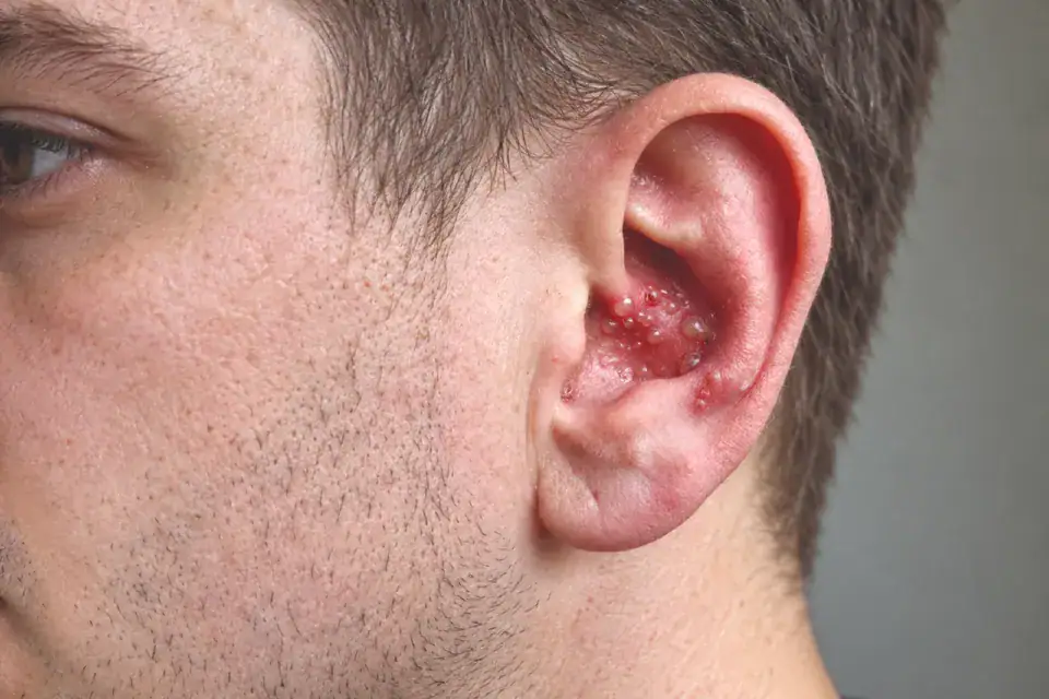 Ramsay Hunt Syndrome in Urgent Care Feature Image