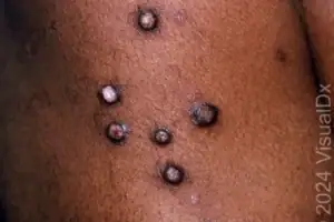 Extremely Itchy Dark-Ringed Bumps