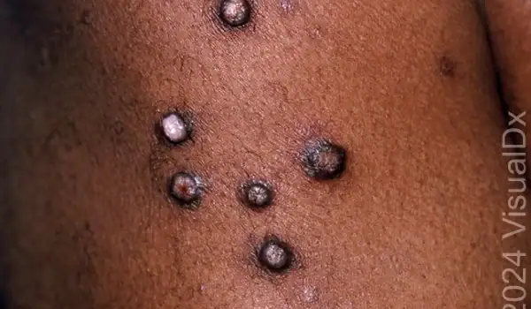 52-Year-Old Female With Extremely Itchy Dark-Ringed Bumps on Skin of Back 52-Year-Old Female With Extremely Itchy Dark-Ringed Bumps on Skin of Back