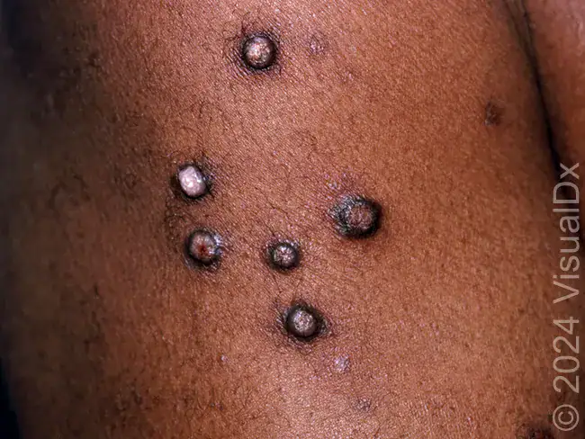 Extremely Itchy Dark-Ringed Bumps, PN
