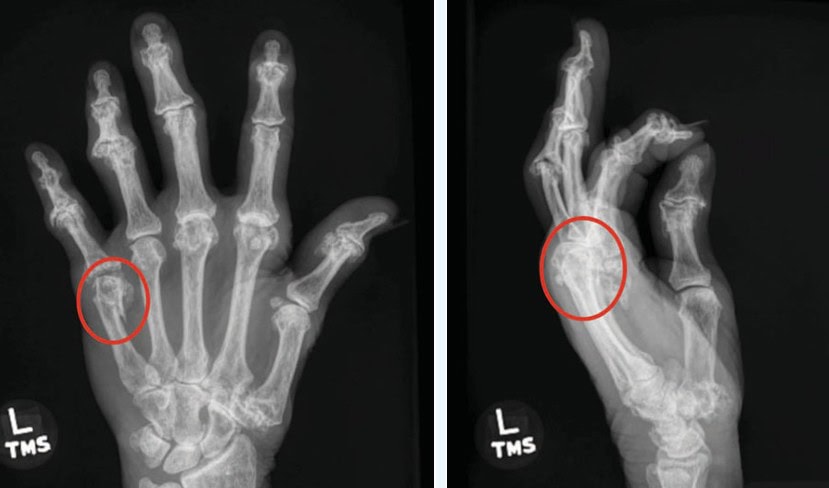 Fifth Metacarpal Neck Fracture in Urgent Care Resolution