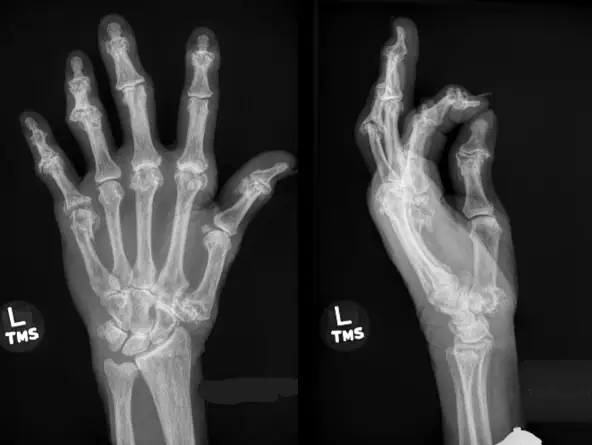 Swollen, Painful Hand After A Fall, Fifth Metacarpal Neck Fracture in Urgent Care