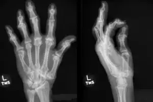 Fifth Metacarpal Neck Fracture in Urgent Care
