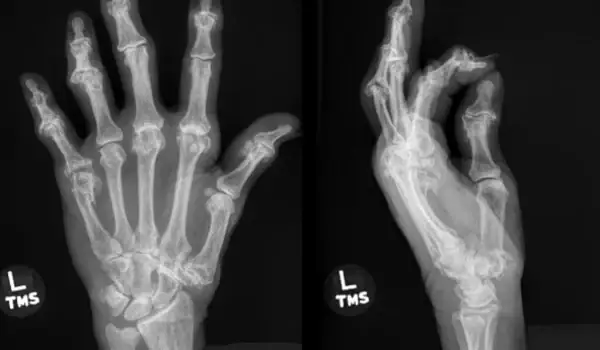 68-Year-Old Female With Swollen, Painful Hand 68-Year-Old Female With Swollen, Painful Hand