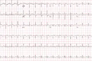 62-Year-Old With Acute Dyspnea