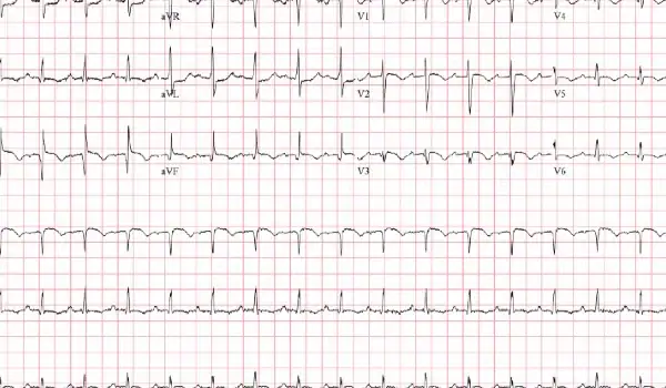 62-Year-Old With Acute Dyspnea 62-Year-Old With Acute Dyspnea