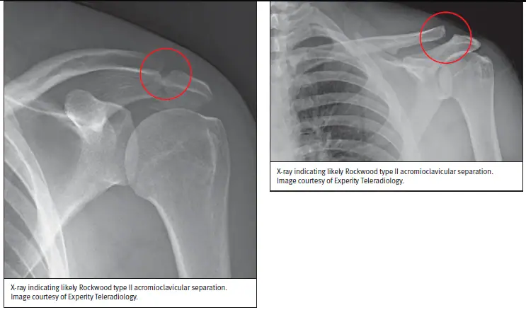 x-ray images showing Rockwood Type II Acromioclavicular Separation