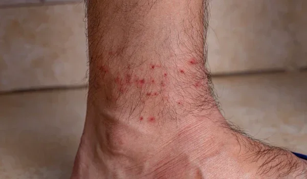Watch For Unique ‘Tick Bomb’ Bite Pattern