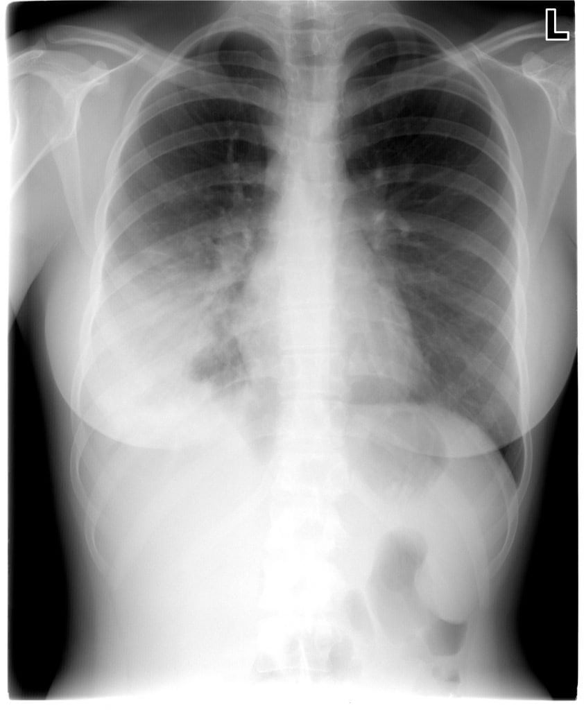 AdultPneumonia_Figure1