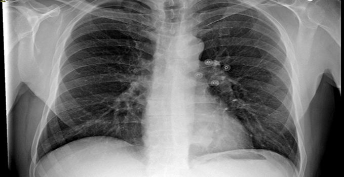 A 51-Year-Old Male with a Persistent Cough