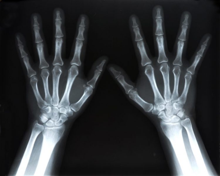 XRay image of human hands Journal of Urgent Care Medicine