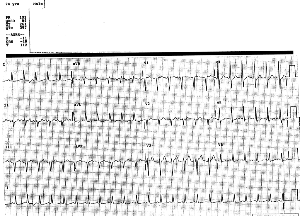 A 74-Year-Old Man with Epigastric Pain