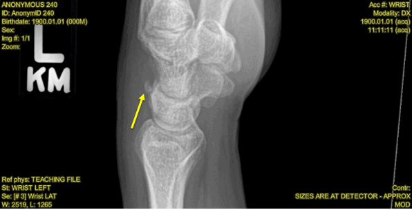 A 41-Year-Old Woman with Wrist Pain After Falling