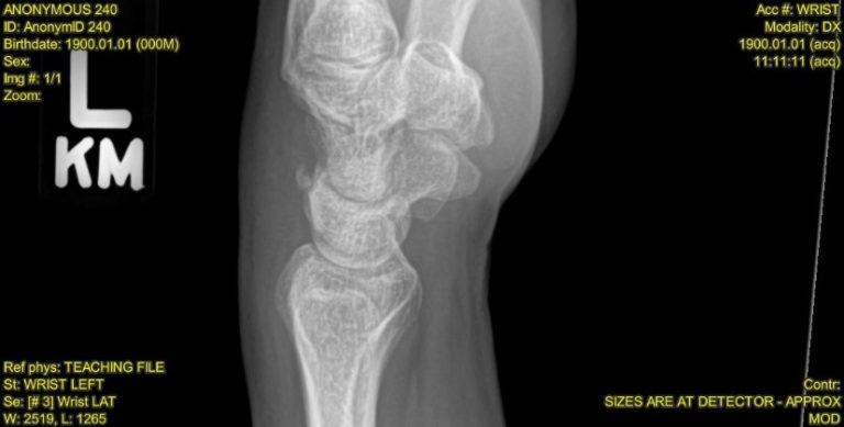 A 41-Year-Old Woman with Wrist Pain After Falling