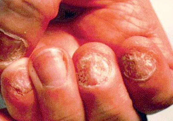 Common Hand Infections