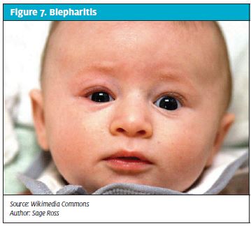 Ocular Complaints in Urgent Care - Blepharitis
